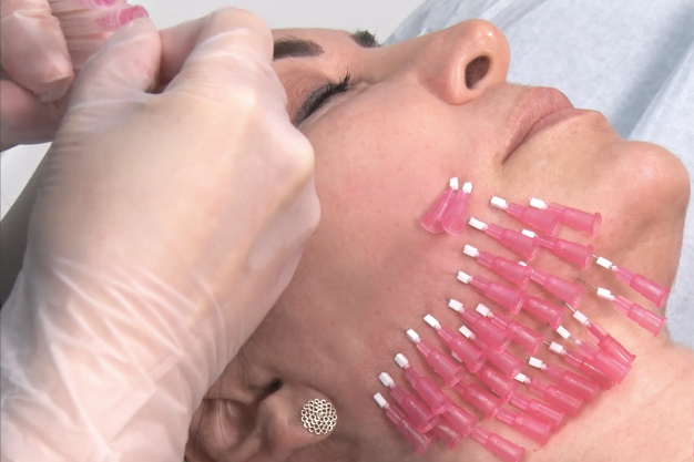 PDO-Mono-Threads-MySkin-Clinics PDO-Mono-Threads-MySkin-Clinics