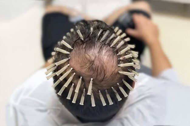 scalp-threading-1024×682 scalp-threading-1024x682